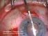 Descemet s Stripping Endothelial Keratoplasty (DSEK)