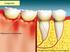 Plaque and periodontal disease