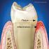 Plaque and periodontal disease