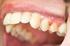 Patient Guide to Periodontal Disease: Causes and Symptoms