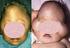 a guide to understanding pfeiffer syndrome