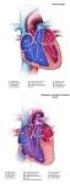 HYPOPLASTIC LEFT HEART SYNDROME