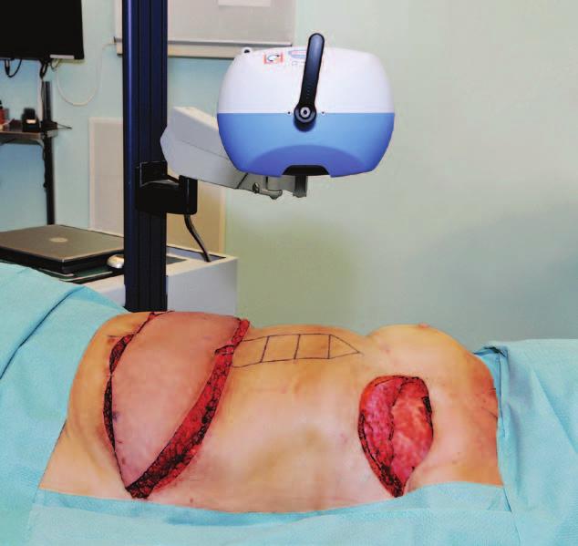 Ingvaldsen et al. Abdominal Skin Perfusion after DIEAP Flap Procedure (while light hitting static objects is unchanged).