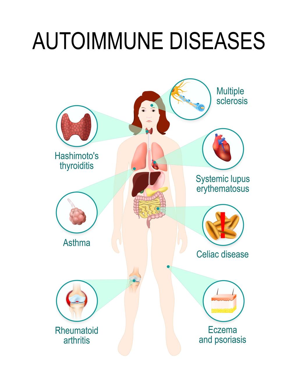 Autoimmunity in the United States National Institutes of Health (NIH) > 100 autoimmune conditions affecting 23.