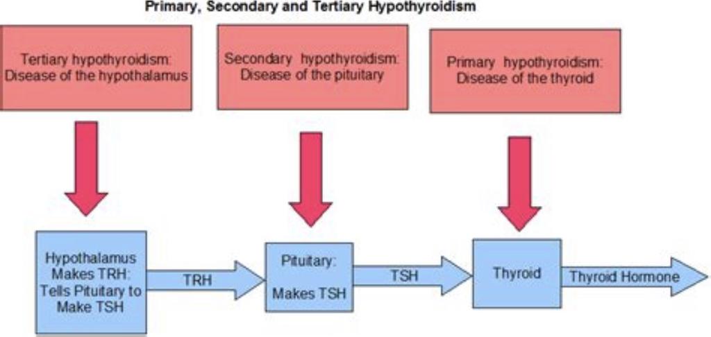 Hypothyroidism Primary Most common form Gland dysfunction Hashimoto s is the most common cause Other causes: endemic iodine deficiency, previous thyroidectomy, previous radioablation, medication