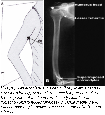 Positioning for a lateral projection of the humerus 3. 4. 5. Place the patient in a seated-upright or standing position facing the x-ray tube.