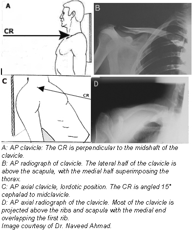 (Fig. 3) Positioning for an AP axial projection of the clavicle 3. 4. 5. Stand or seat the patient 1 foot (30 cm) in front of the vertical cassette device, with the patient facing the x-ray tube.