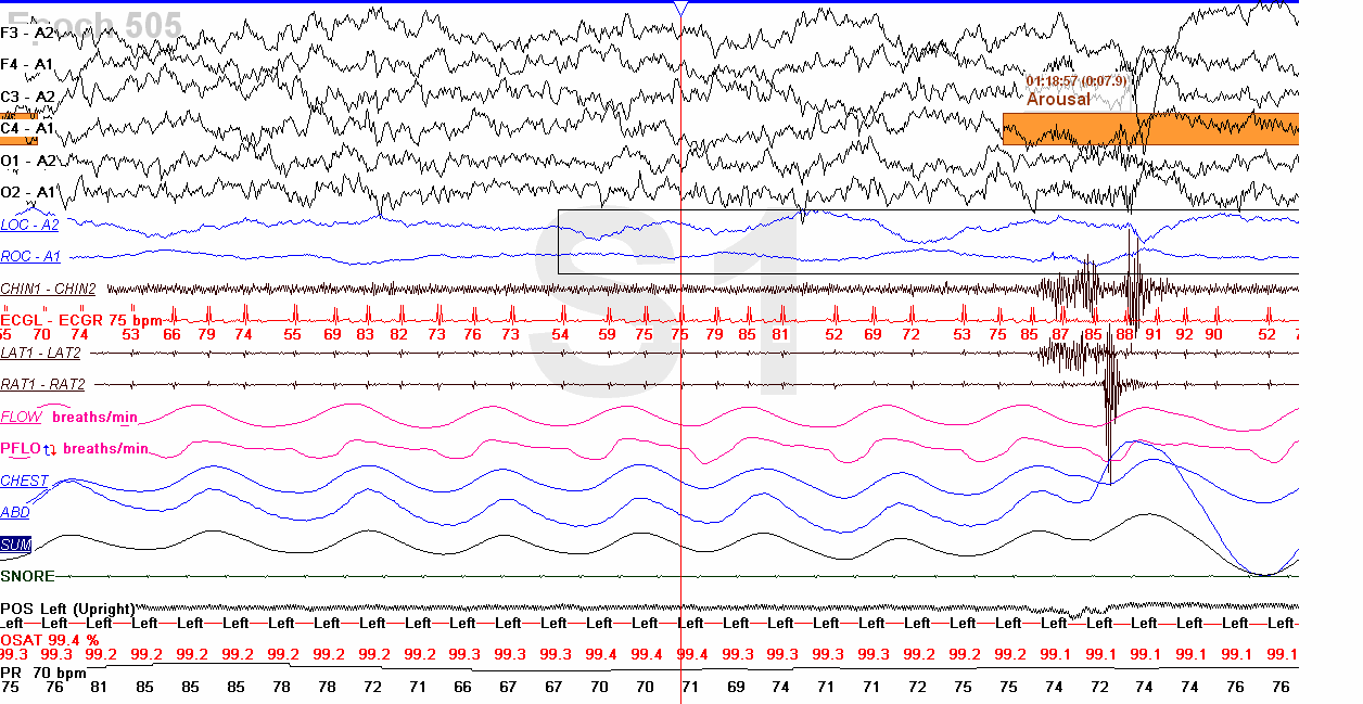 Figure 1.1.a: PSG recording of awake child. Alpha waves (rectangle) are visible especially above the occipital region, EEG channels O1 and O2. The eyes are open, blinking occasionally (ellipses).