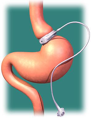 Lap Band Gastric Bypass