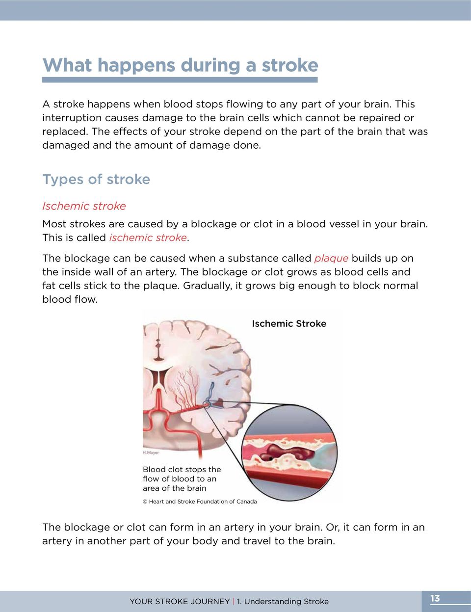 Types of stroke Ischemic stroke Most strokes are caused by a blockage or clot in a blood vessel in your brain. This is called ischemic stroke.