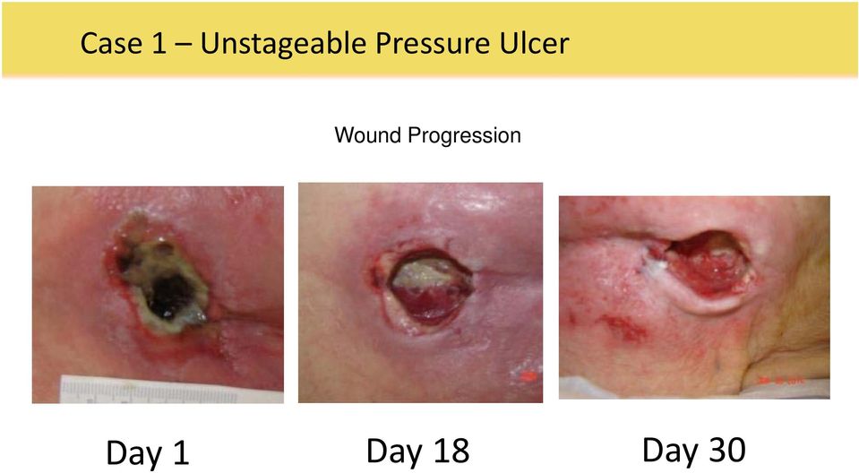 Pressure Ulcer