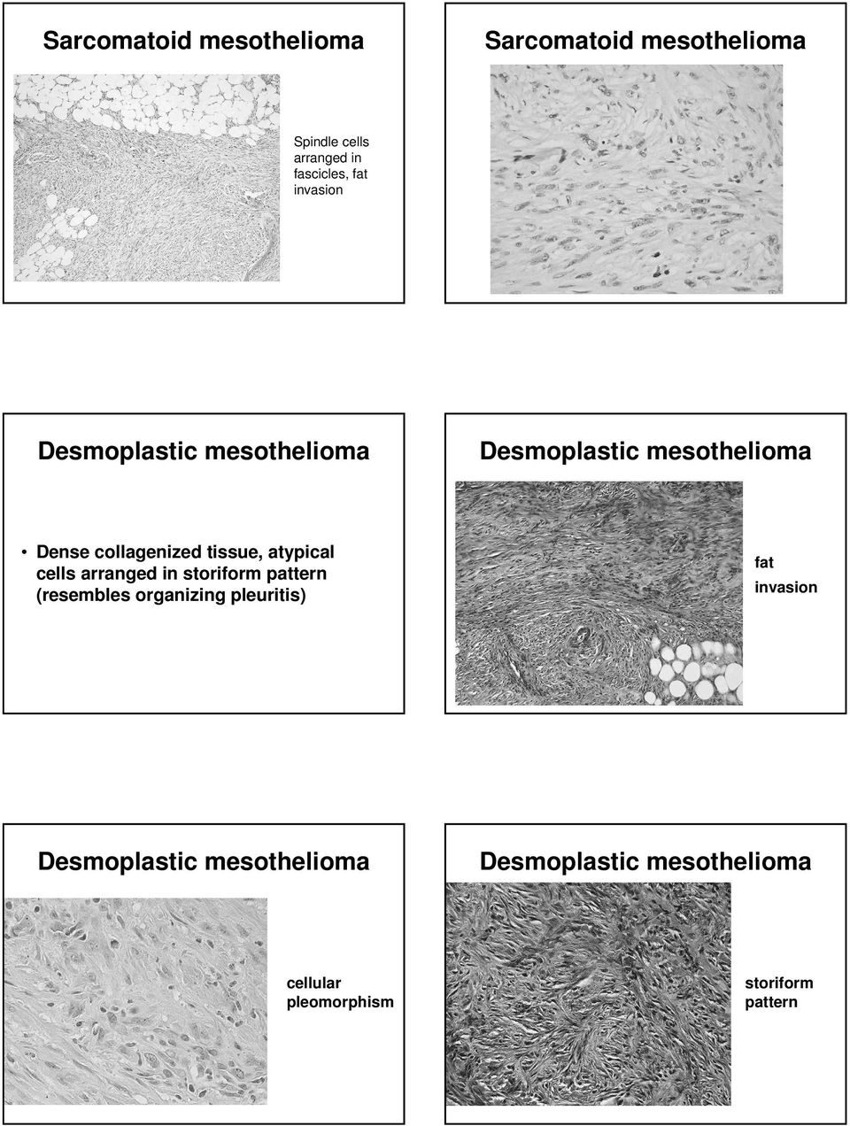 storiform pattern (resembles organizing pleuritis) Desmoplastic mesothelioma cellular