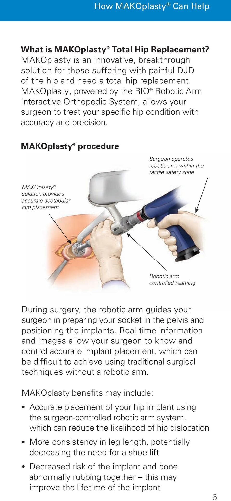 MAKOplasty procedure Surgeon operates robotic arm within the tactile safety zone MAKOplasty solution provides accurate acetabular cup placement Robotic arm controlled reaming During surgery, the