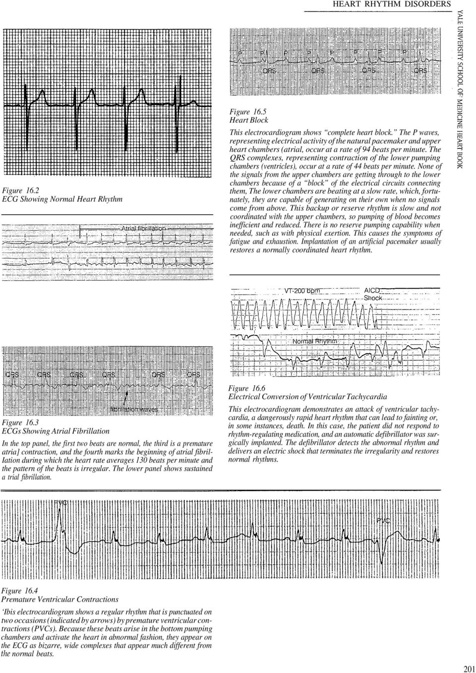 The QRS complexes, representing contraction of the lower pumping chambers (ventricles), occur at a rate of 44 beats per minute.