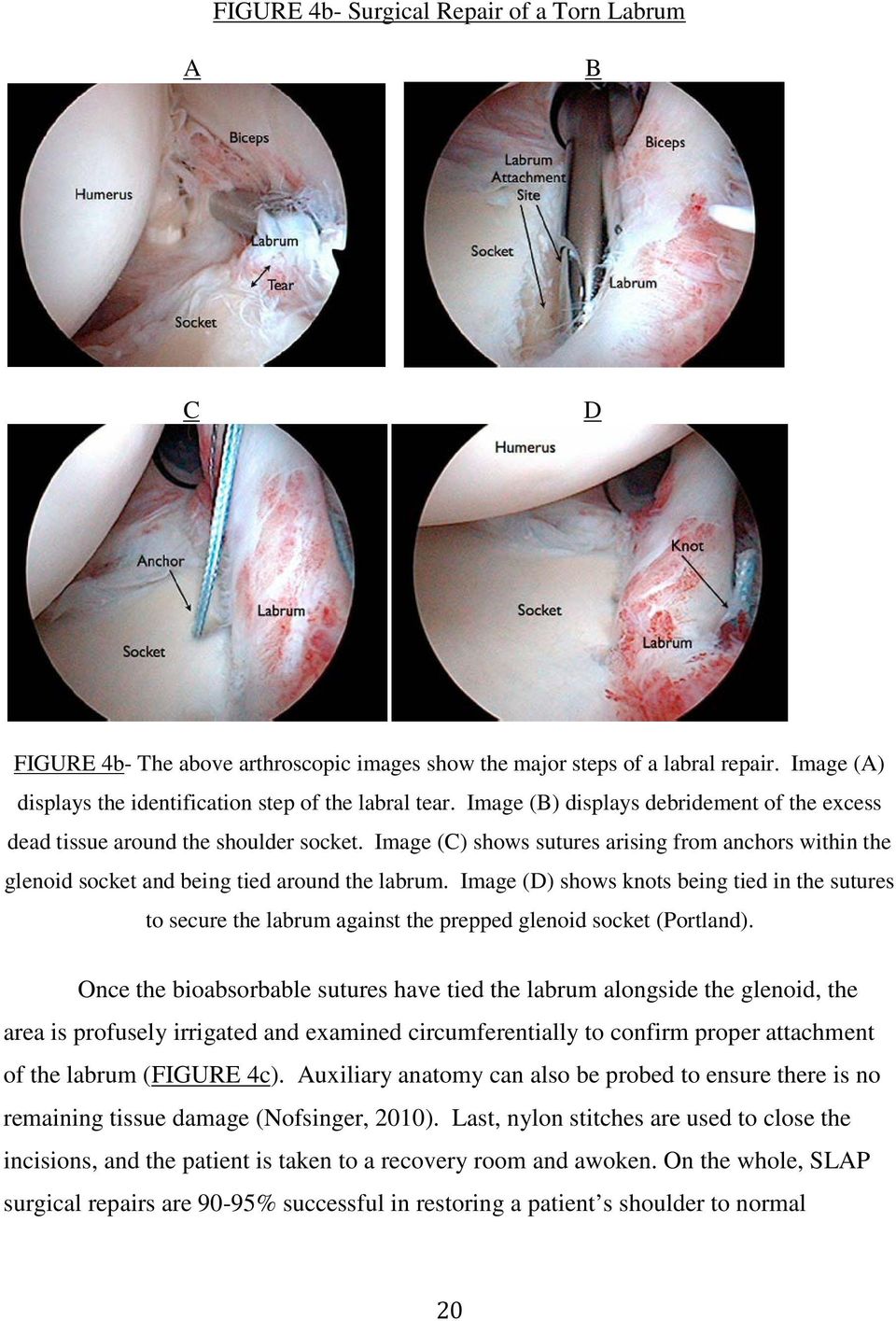 Image (D) shows knots being tied in the sutures to secure the labrum against the prepped glenoid socket (Portland).