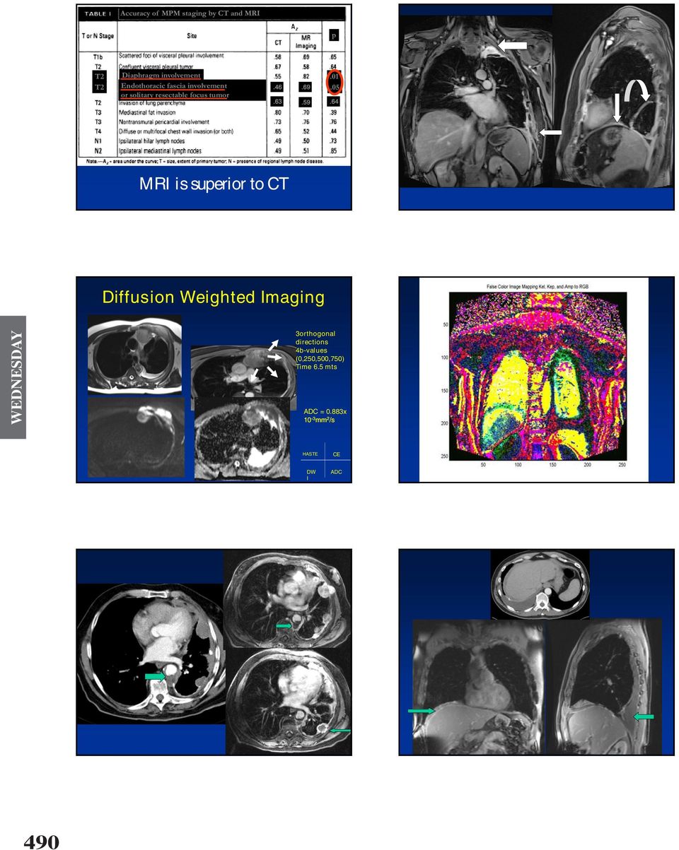 05 MRI is superior to CT Diffusion Weighted Imaging 3orthogonal directions