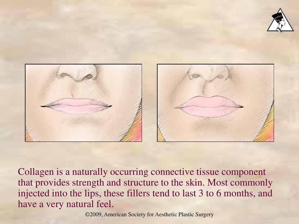skin. Most commonly injected into the lips, these