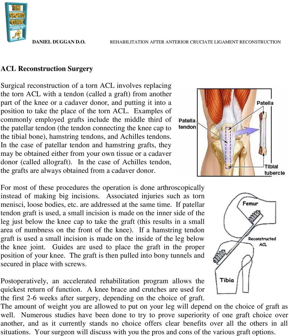 Examples of commonly employed grafts include the middle third of the patellar tendon (the tendon connecting the knee cap to the tibial bone), hamstring tendons, and Achilles tendons.