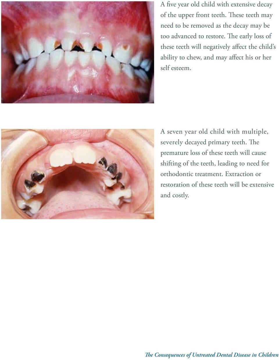 The early loss of these teeth will negatively affect the child s ability to chew, and may affect his or her self esteem.