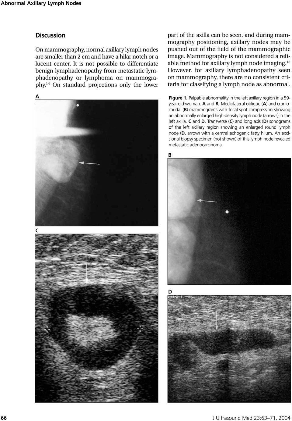 14 On standard projections only the lower A part of the axilla can be seen, and during mammography positioning, axillary nodes may be pushed out of the field of the mammographic image.