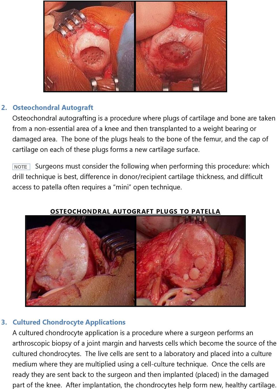 NOTE Surgeons must consider the following when performing this procedure: which drill technique is best, difference in donor/recipient cartilage thickness, and difficult access to patella often