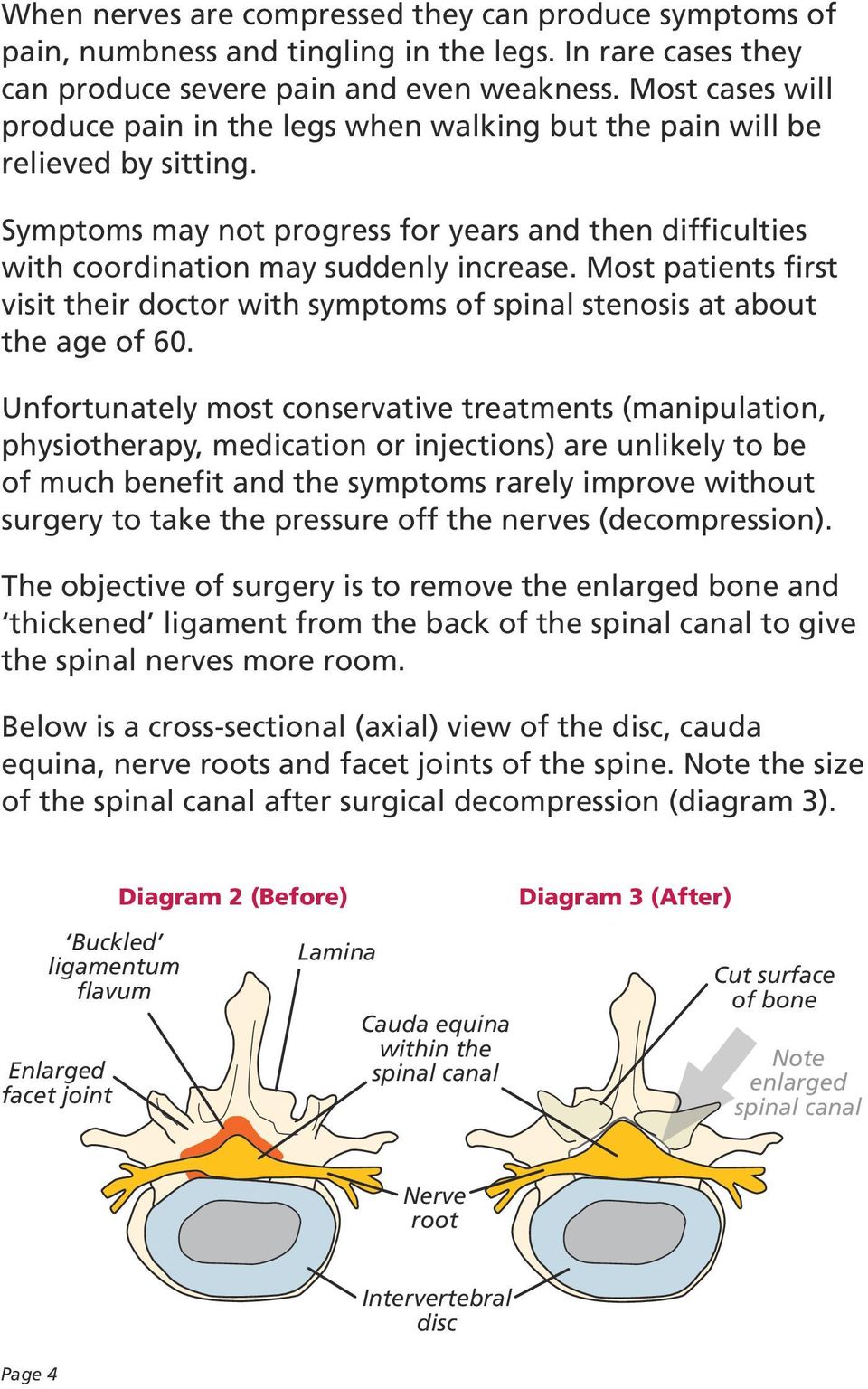 Most patients first visit their doctor with symptoms of spinal stenosis at about the age of 60.