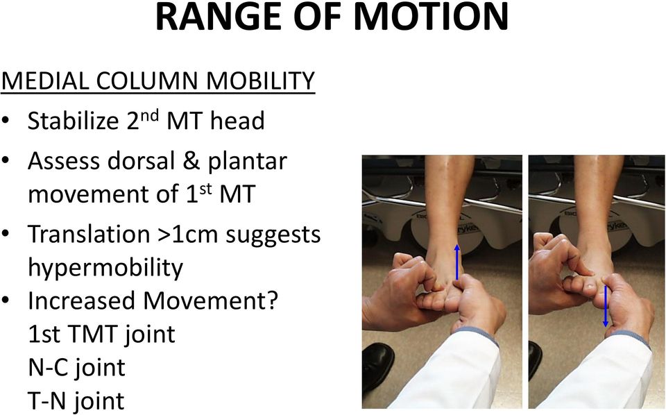 1 st MT Translation >1cm suggests hypermobility