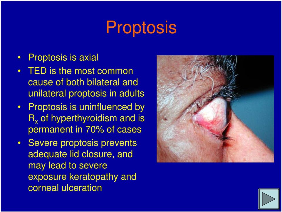 hyperthyroidism and is permanent in 70% of cases Severe proptosis prevents