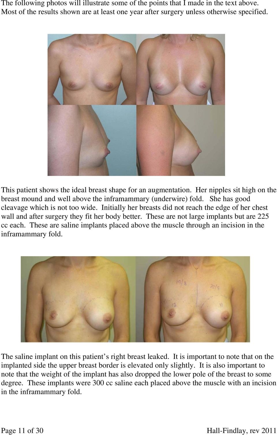 Initially her breasts did not reach the edge of her chest wall and after surgery they fit her body better. These are not large implants but are 225 cc each.