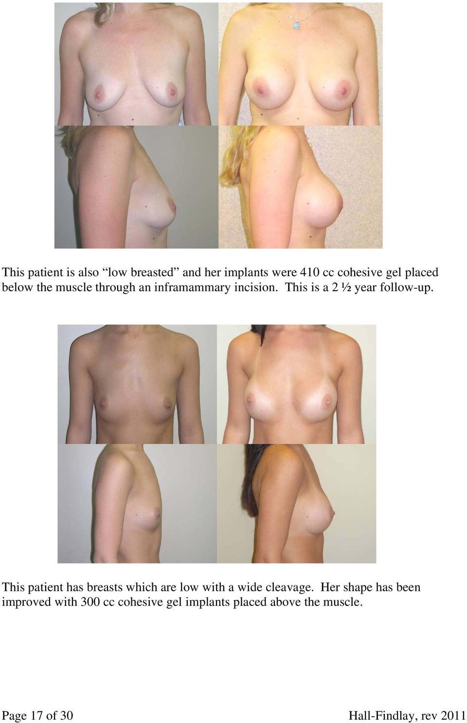 This patient has breasts which are low with a wide cleavage.