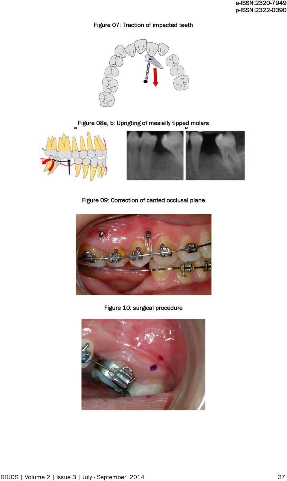 Correction of canted occlusal plane Figure 10: