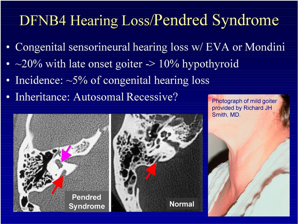 Incidence: ~5% of congenital hearing loss Inheritance: Autosomal Recessive?