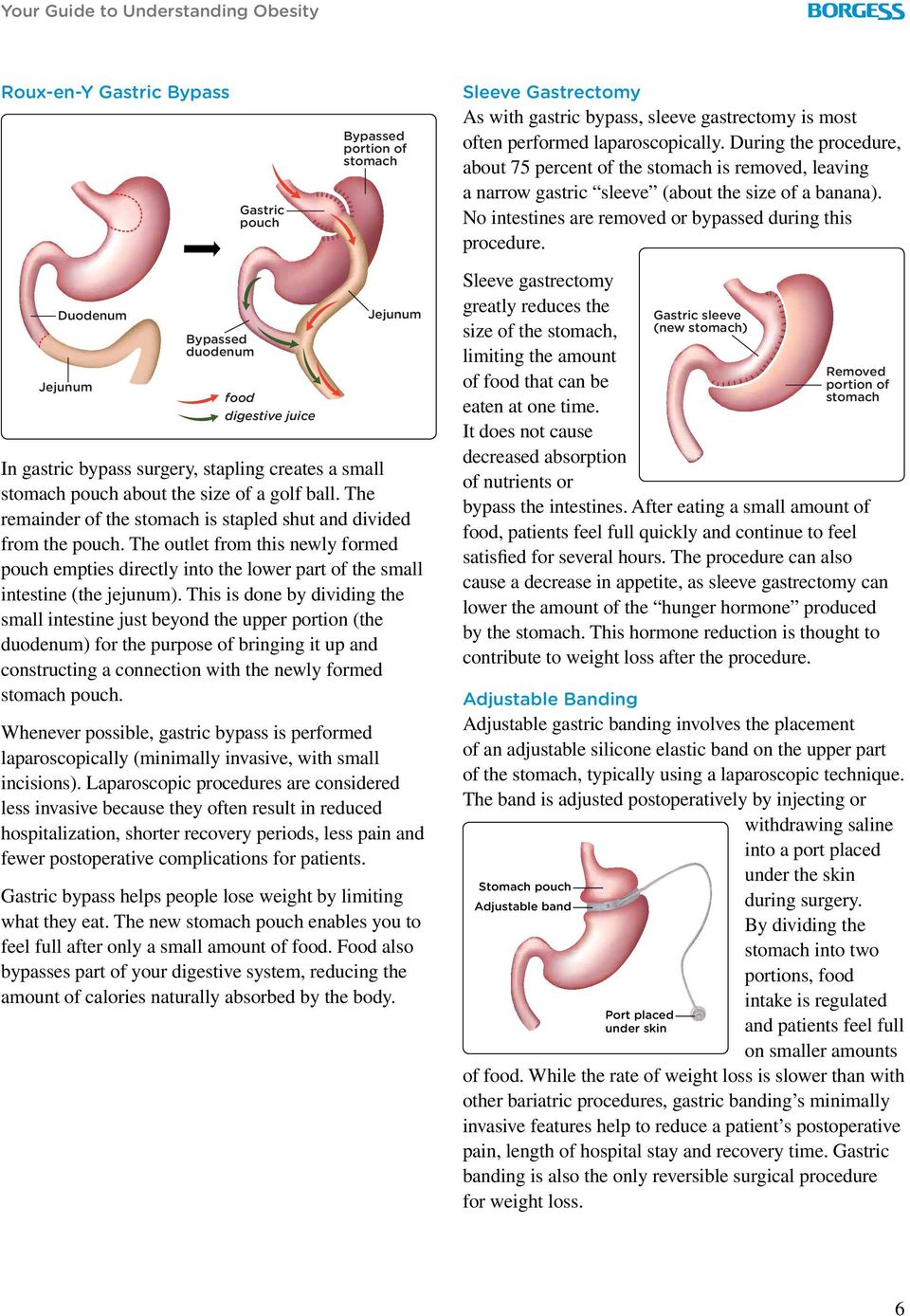 Duodenum Jejunum Bypassed duodenum food digestive juice Jejunum In gastric bypass surgery, stapling creates a small stomach pouch about the size of a golf ball.