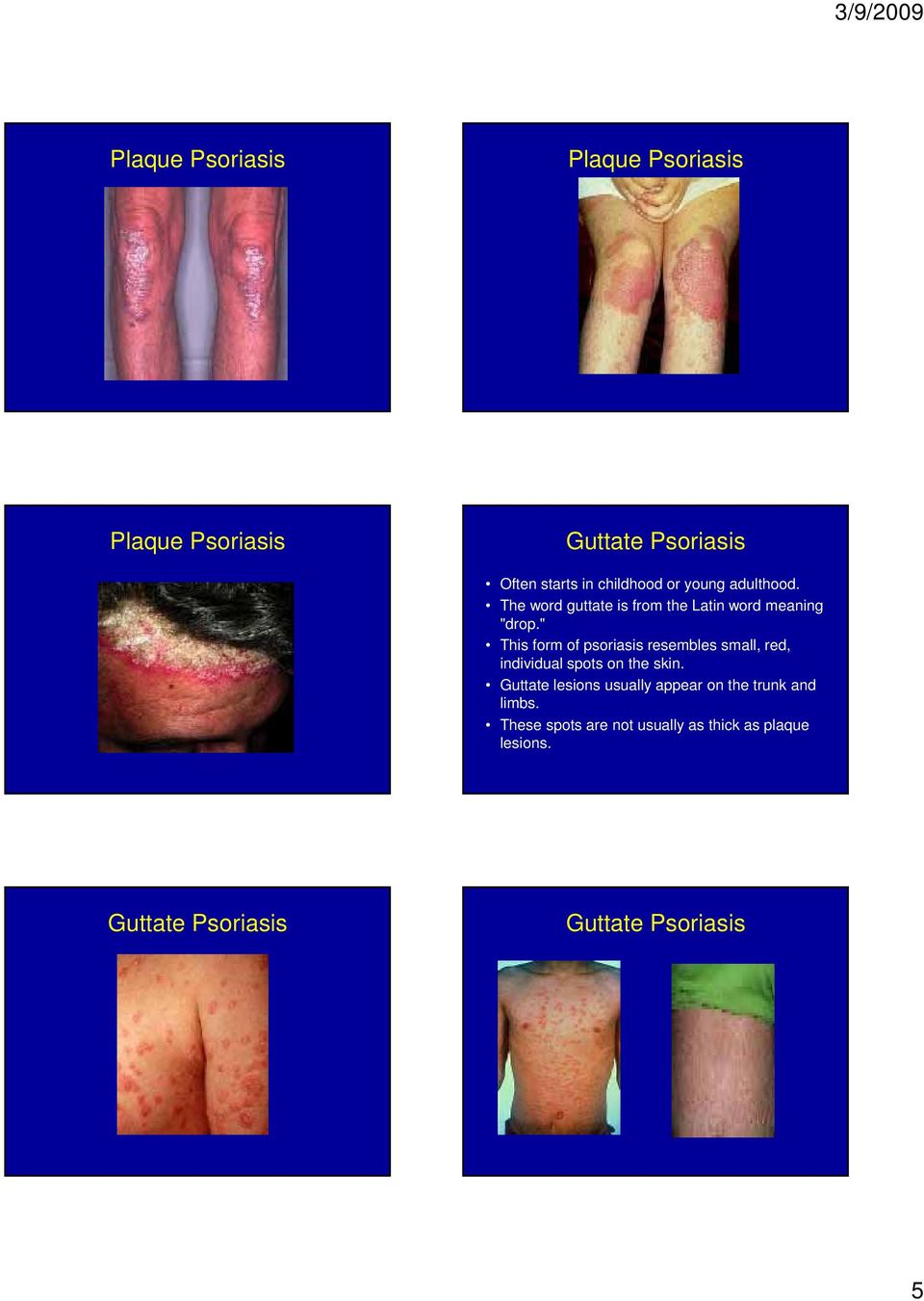 " This form of psoriasis resembles small, red, individual spots on the skin.