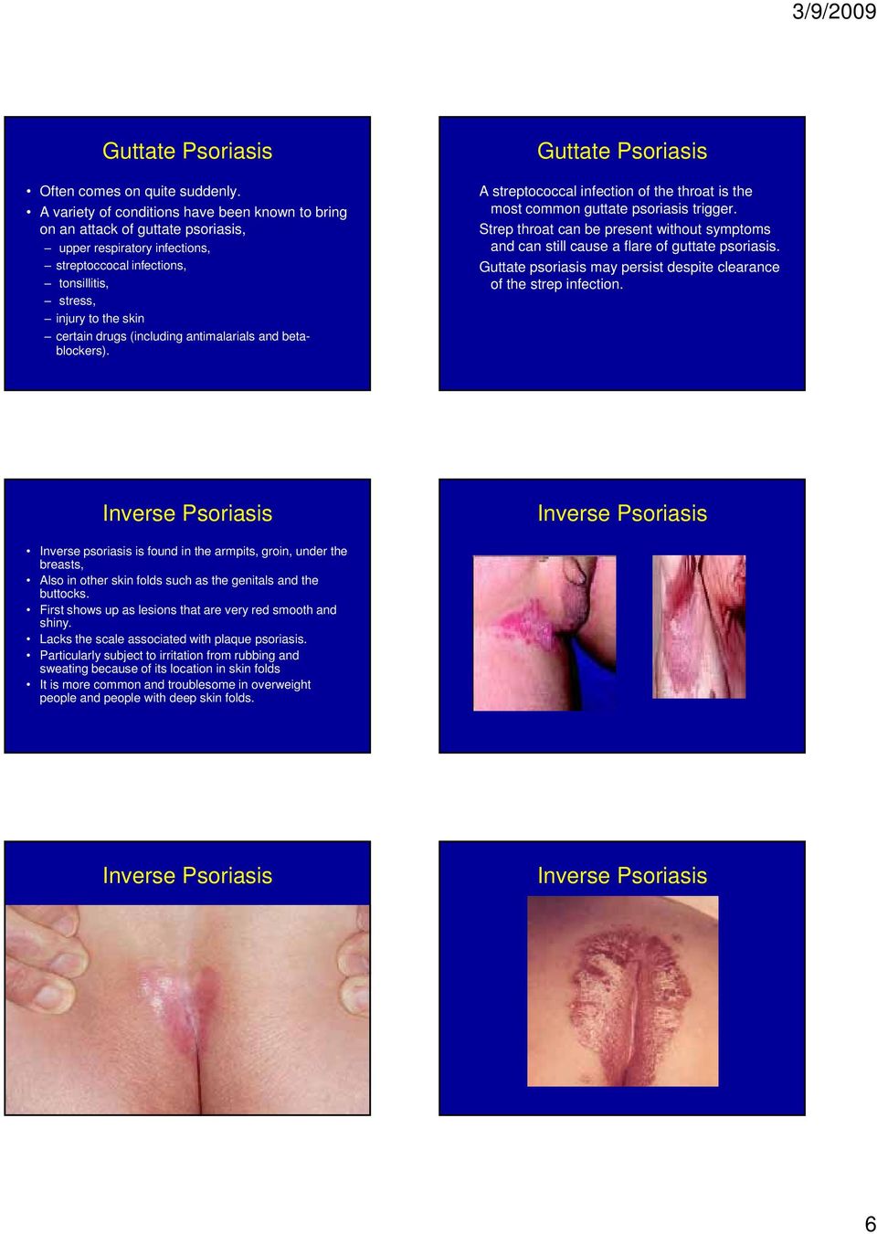 (including antimalarials and betablockers). Guttate Psoriasis A streptococcal infection of the throat is the most common guttate psoriasis trigger.