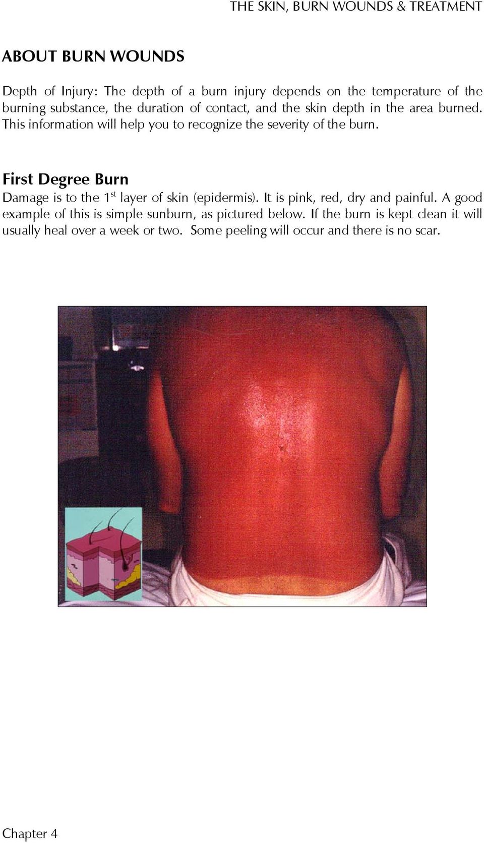 First Degree Burn Damage is to the 1 st layer of skin (epidermis). It is pink, red, dry and painful.