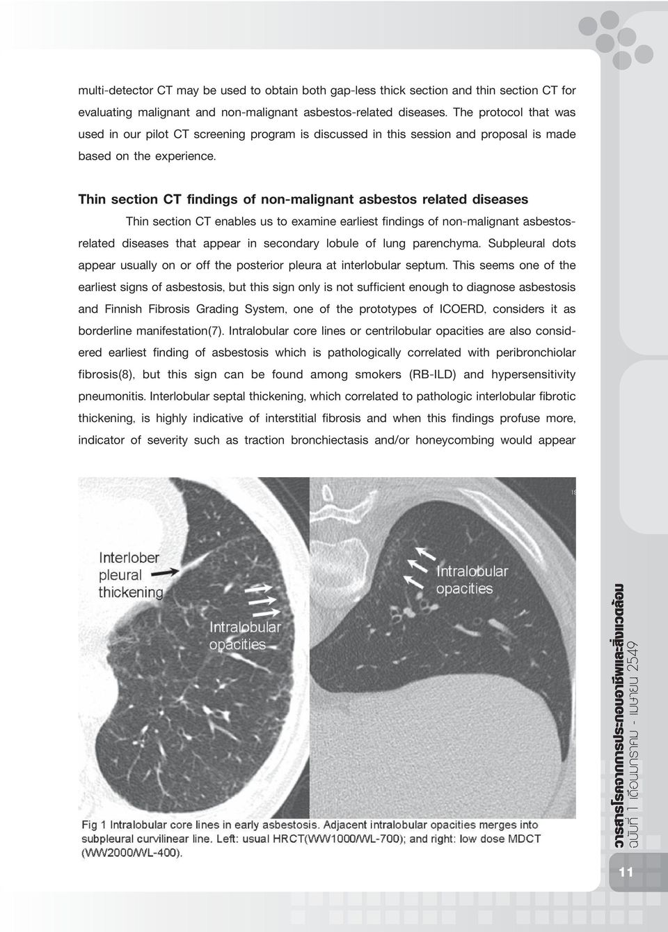 Thin section CT findings of non-malignant asbestos related diseases Thin section CT enables us to examine earliest findings of non-malignant asbestosrelated diseases that appear in secondary lobule