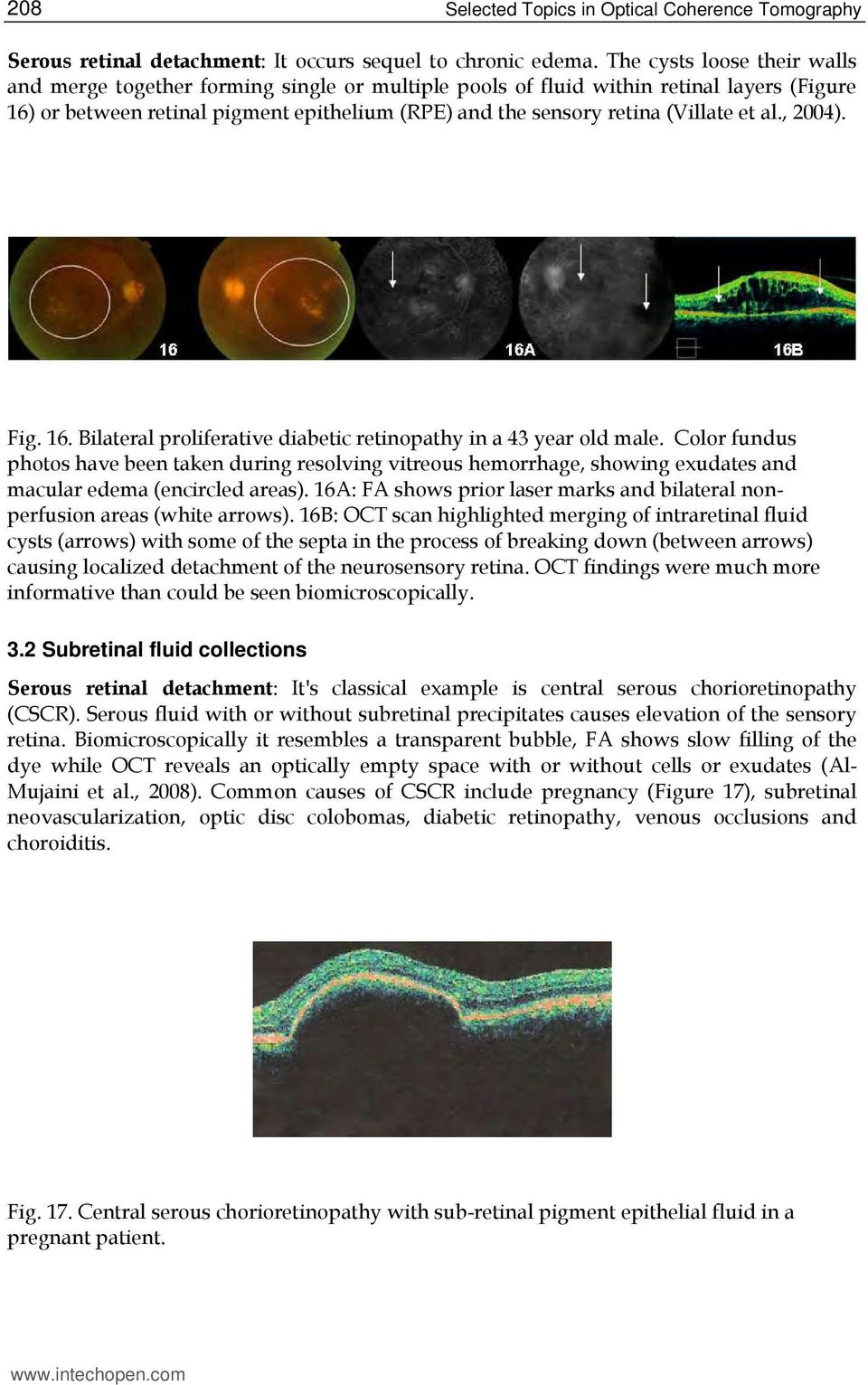 et al., 2004). Fig. 16. Bilateral proliferative diabetic retinopathy in a 43 year old male.