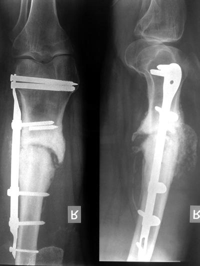 osteosinteza femura cum să tratezi artrita de genunchi și artroza