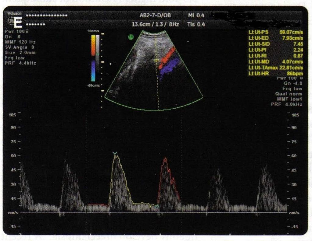 Ultrazvuk bubrežnih žila i arterija: priprema za dopler sonografiju bubrega (UZDG)