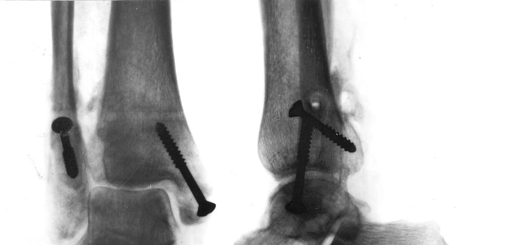 Artroza articulației talusului navicular, 2 grade