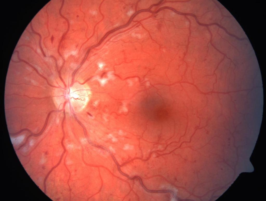 retinalna promjene hipertenzije