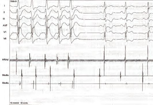 RFA (ablația de frecvență radio) a inimii