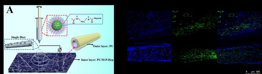 Electrospun bilayer composite vascular graft with an inner layer modified by PEG and Haparin to regenerate the blood vessel Haizhu Kuang 1, Peng Zhang 1,* 1 Shenzhen Luohu People s Hospital, Shenzhen