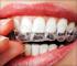 Tooth Whitening/Bleaching: Treatment Considerations for Dentists and Their Patients