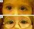 Care of the Patient with Strabismus: Esotropia and Exotropia