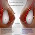 Eurosilicone. Options for Breast Augmentation