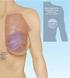 INFORMED CONSENT OPEN CAPSULECTOMY WITH BREAST IMPLANT REPLACEMENT USING SILICONE GEL-FILLED IMPLANTS