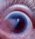 Corneal diseases and corneal transplantation