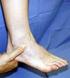 Ankle sprains, especially of the lateral
